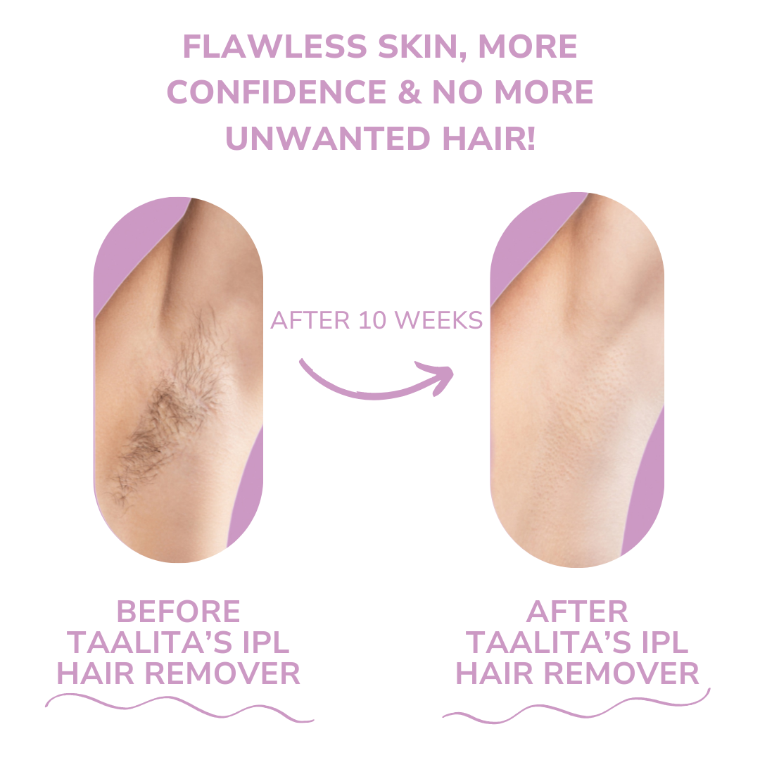 Mini Laser Hair Remover - Shopmixpro