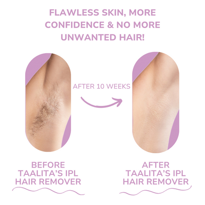 Mini Laser Hair Remover - Shopmixpro
