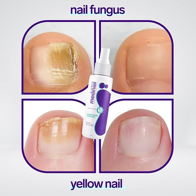 Nail Fungus Spray - Shopmixpro