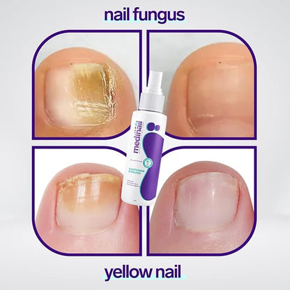 Nail Fungus Spray - Shopmixpro